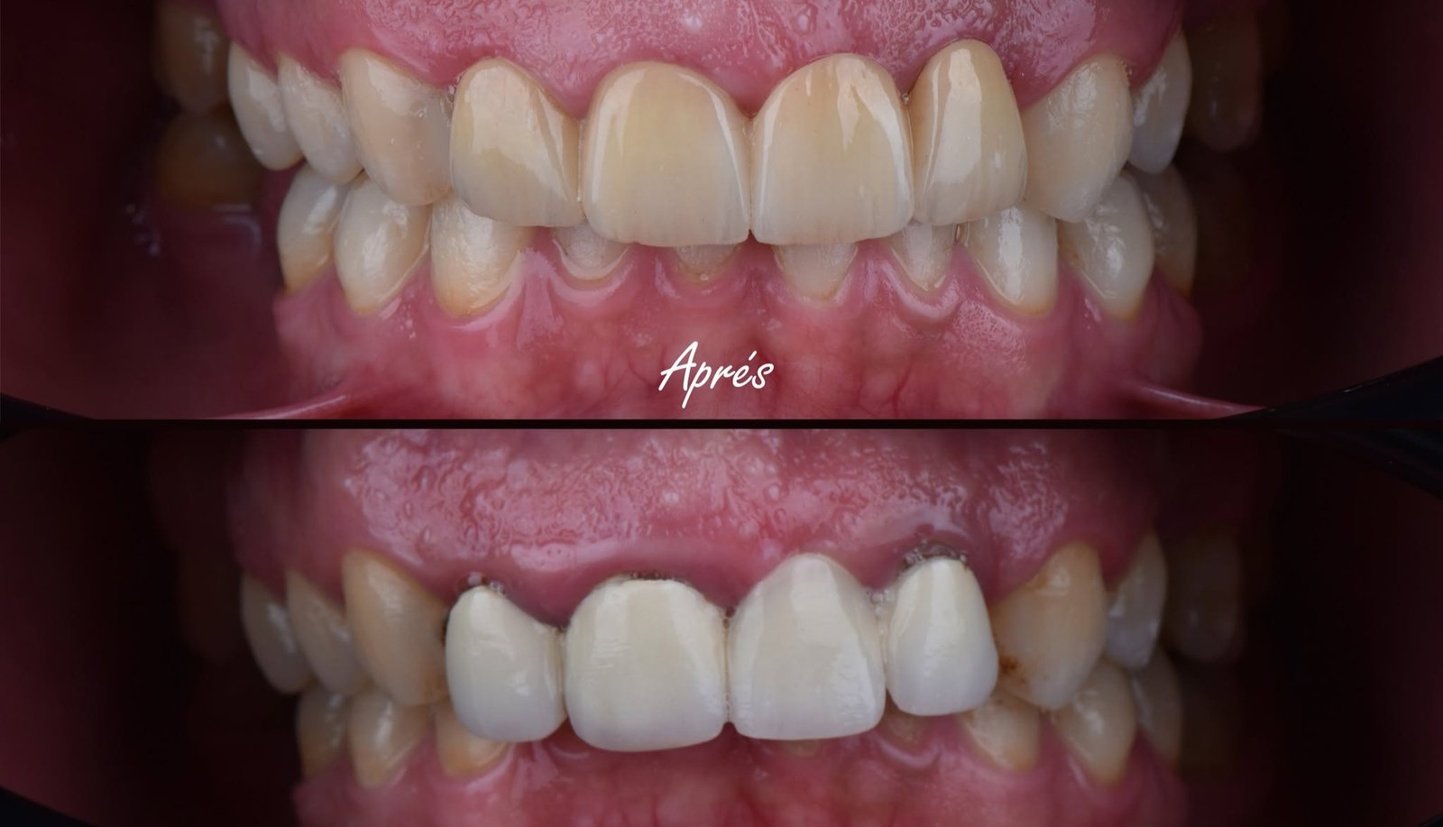 Photo avant / après d'un sourire, exemple de contenu produit